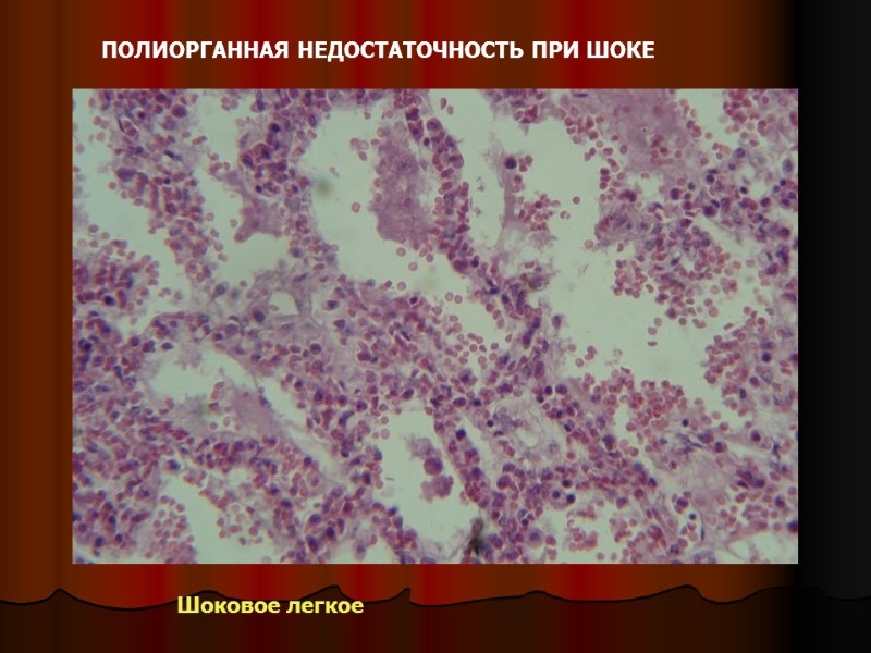 ПОЛИОРГАННАЯ НЕДОСТАТОЧНОСТЬ ПРИ ШОКЕ Шоковое легкое